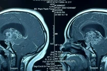 Phẫu thuật khẩn cấp cứu chàng trai 21 tuổi hôn mê sâu do u sọ hầu tái phát