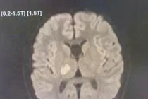 Bất ngờ trẻ 13 tuổi đang khỏe mạnh thì đột quỵ