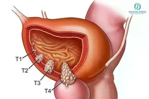 Mỗi năm 1000 người tử vong vì ung thư bàng quang, cách gì phòng tránh?