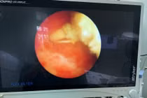 Vòng tránh thai 10 năm lạc chỗ vào bàng quang tạo sỏi