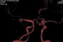 Chủ quan đau đầu có thể vỡ túi phình mạch máu não đe dọa tính mạng