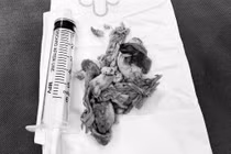 Cấp cứu thành công cụ ông 71 tuổi nghẹn thịt gà trong thực quản