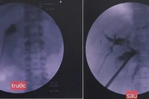 Tán sỏi túi mật xuyên gan qua da