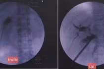 Tán sỏi túi mật xuyên gan qua da