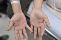 Chơi bóng cười cho vui, hai vợ chồng liệt nửa người 