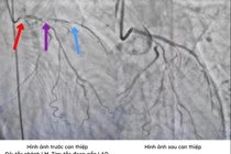 Bệnh nhân hai lần ngừng tim được cứu sống nhờ can thiệp kịp thời