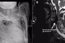 Hiếm gặp: Rò động tĩnh mạch cột sống liệt tứ chi trên nền gù vẹo nặng