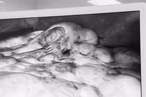 Đau bụng âm ỉ không ngờ u mạc treo ruột khổng lồ dính hết ổ bụng