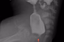 Nội soi điều trị bệnh không hậu môn cho trẻ sơ sinh tại Hải Phòng