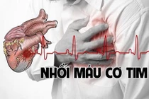 Người bệnh đái tháo đường tắc nghẽn hoàn toàn động mạch vành