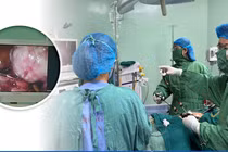 Ra máu âm đạo, người phụ nữ 46 tuổi không ngờ u xơ tử cung biến chứng