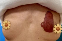 Thói quen dán cao lên u vú gây hại nghiêm trọng