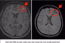 Chẩn đoán nhanh bằng MRI, cô gái 25 tuổi thoát nguy cơ xuất huyết não 