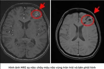 Chẩn đoán nhanh bằng MRI, cô gái 25 tuổi thoát nguy cơ xuất huyết não 