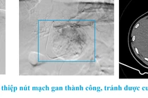 Đau chướng bụng do u gan chảy máu tràn dịch màng bụng