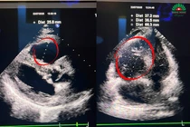 Đau tức ngực, suy hô hấp vì thuốc tránh thai gây thuyên tắc phổi