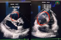 Đau tức ngực, suy hô hấp vì thuốc tránh thai gây thuyên tắc phổi