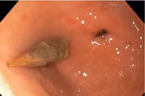 Gắp thành công dị vật hạt táo đỏ đâm vào thành dạ dày người bệnh