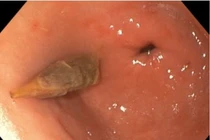 Gắp thành công dị vật hạt táo đỏ đâm vào thành dạ dày người bệnh