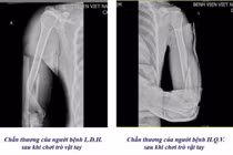 1 tuần 3 trường hợp gãy xương cánh tay từ trò chơi vật tay