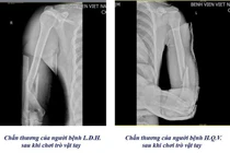 1 tuần 3 trường hợp gãy xương cánh tay từ trò chơi vật tay