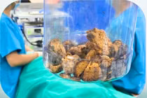 Lấy bã thức ăn 'khổng lồ' 15cm trong dạ dày cụ bà 85 tuổi thích ăn hồng ngâm