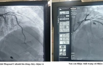 Hồi sinh sự sống cho người bệnh đau ngực cấp do nhồi máu cơ tim