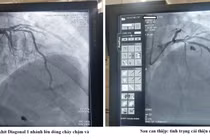 Hồi sinh sự sống cho người bệnh đau ngực cấp do nhồi máu cơ tim