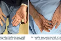 Hút nhiều cục máu đông giúp bệnh nhân 97 tuổi tránh nguy cơ hoại tử