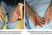 Hút nhiều cục máu đông giúp bệnh nhân 97 tuổi tránh nguy cơ hoại tử