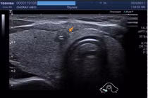 Không có triệu chứng, phát hiện ung thư tuyến giáp 2 bên kèm hạch cổ