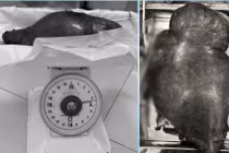 Cắt khối u nặng 4,5 kg cho người phụ nữ đợi suốt 10 năm chờ u biết mất