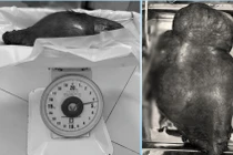 Cắt khối u nặng 4,5 kg cho người phụ nữ đợi suốt 10 năm chờ u biết mất