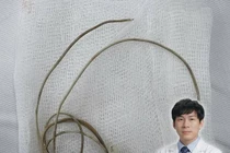 Lấy dị vật trong bàng quang cho nam sinh 16 tuổi