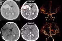 Cứu sống bệnh nhi hôn mê do vỡ dị dạng mạch máu não bị bệnh cơ tim hiếm gặp