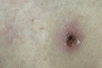 Căn bệnh nguy hiểm gây nhiễm khuẩn huyết từ vết cắn nhỏ của mò