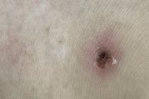 Căn bệnh nguy hiểm gây nhiễm khuẩn huyết từ vết cắn nhỏ của mò