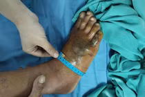 Người đàn ông Ninh Bình hoại tử chân vì bị rắn lục cắn