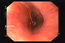 Cây kim băng dài nhọn kẹt trong lòng thực quản bé 12 tháng