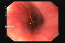 Cây kim băng dài nhọn kẹt trong lòng thực quản bé 12 tháng