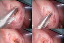 Trẻ 6 tuổi ngã xe đạp điện đau bụng, không ngờ vỡ ruột