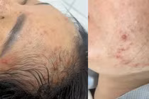 Thủy đậu trong thai kỳ, nguy cơ 'kép' cho cả mẹ và con