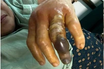 Bàn tay của bệnh nhân