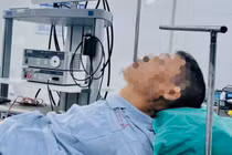 Gây tê tủy sống cho bệnh nhân cột sống cong gù