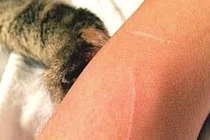 Rét lạnh, sốt cao người đàn ông 71 tuổi tử vong vì bệnh dại do mèo cào