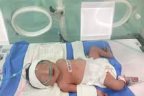 Chạy đua với tử thần cứu sống sản phụ và thai nhi 34 tuần, rau bong non