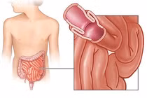 Lồng ruột trẻ em, phát hiện điều trị sớm để bảo vệ tính mạng