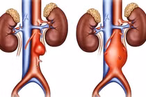 Động mạch chủ bụng phình to gấp ba bình thường sau cơn đau bụng