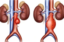 Động mạch chủ bụng phình to gấp ba bình thường sau cơn đau bụng