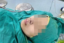 Mổ lần 3 tìm lại nụ cười cho hai chị em bị dị tật khe hở môi mũi bẩm sinh